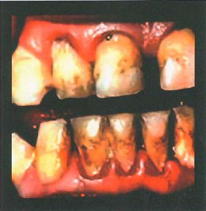 Madagascar 2013-2014  Health Effects mouth - diseased organ, gross